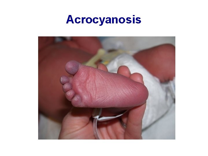 Acrocyanosis 