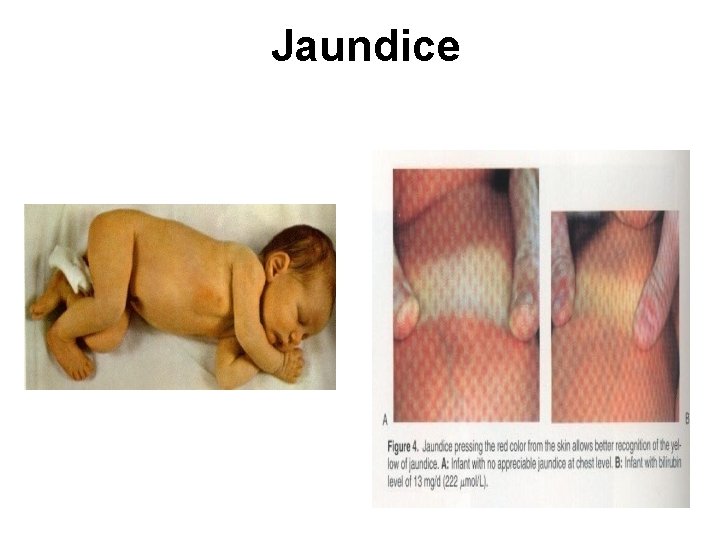 Jaundice 