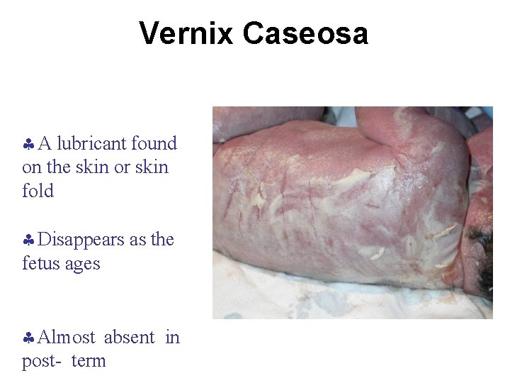 Vernix Caseosa A lubricant found on the skin or skin fold Disappears as the