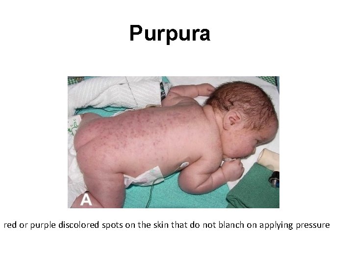 Purpura red or purple discolored spots on the skin that do not blanch on