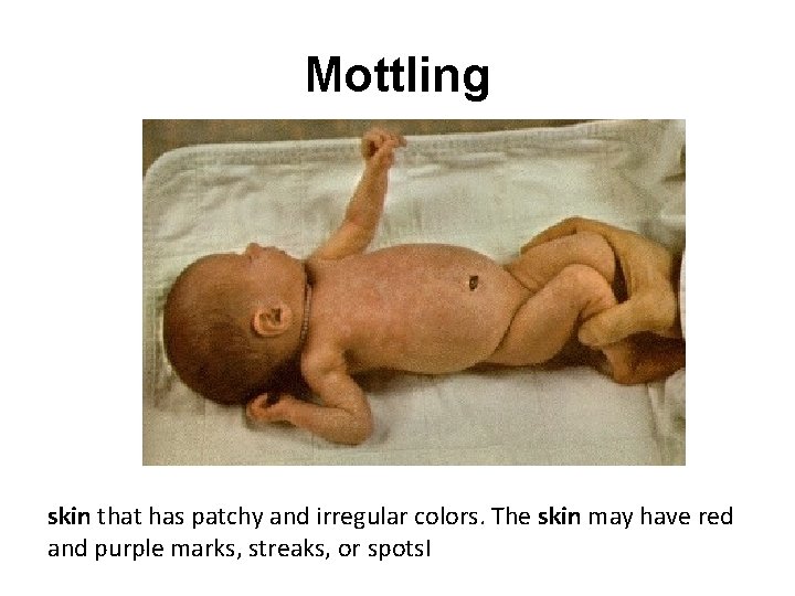 Mottling skin that has patchy and irregular colors. The skin may have red and