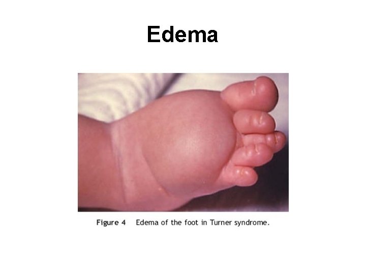 Edema 