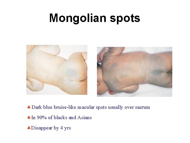 Mongolian spots Dark blue bruise-like macular spots usually over sacrum In 90% of blacks