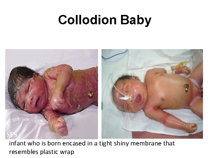 Collodion Baby infant who is born encased in a tight shiny membrane that resembles