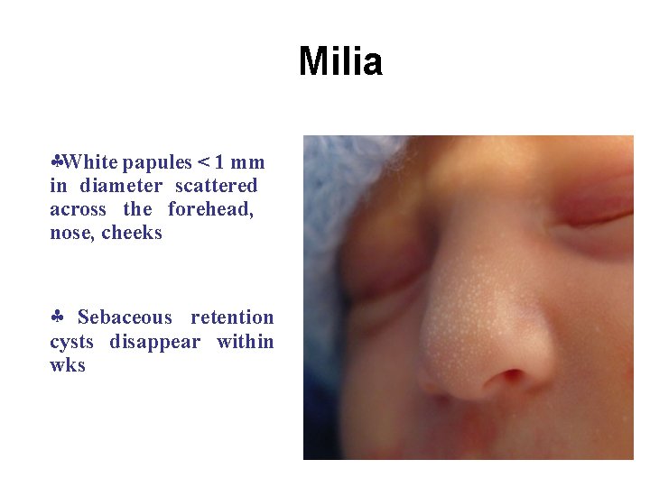 Milia White papules < 1 mm in diameter scattered across the forehead, nose, cheeks