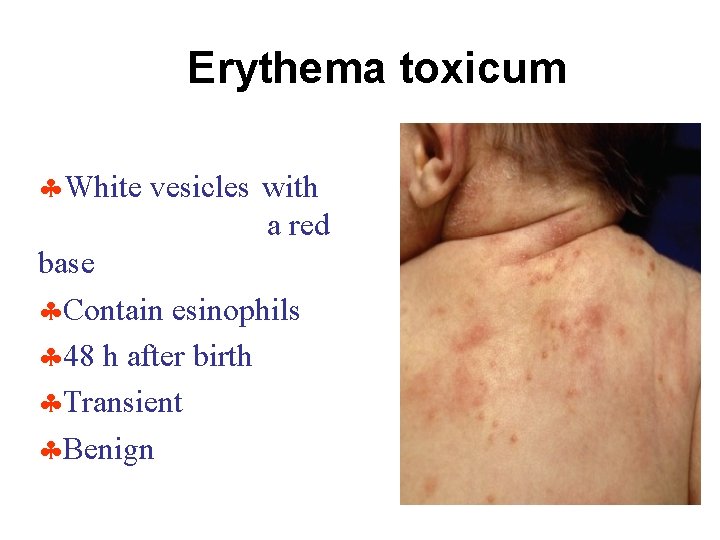 Erythema toxicum White vesicles with a red base Contain esinophils 48 h after birth
