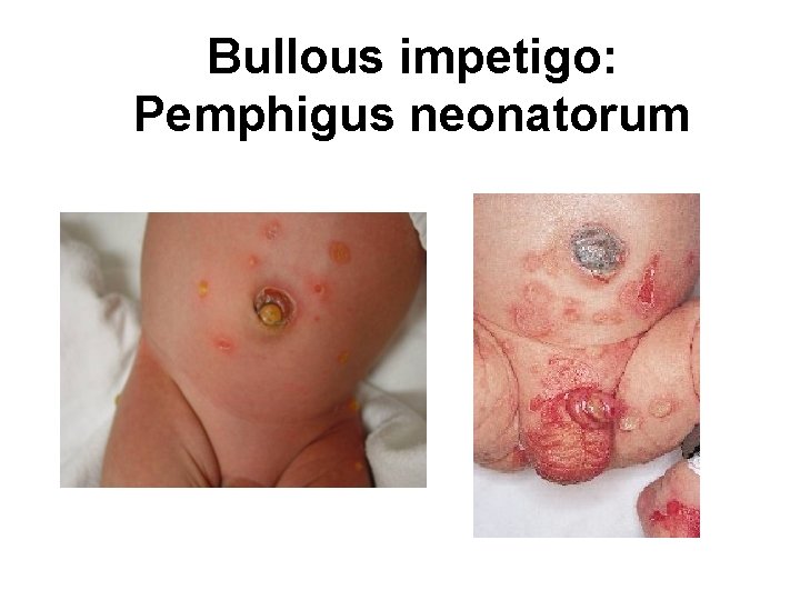 Bullous impetigo: Pemphigus neonatorum 