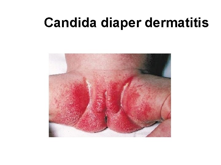 Candida diaper dermatitis 