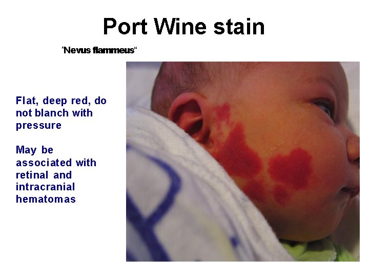 Port Wine stain ”Nevus flammeus“ Flat, deep red, do not blanch with pressure May