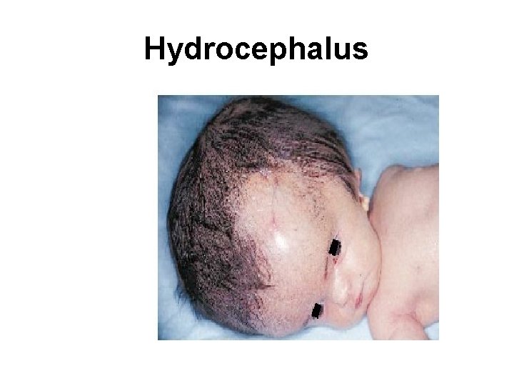 Hydrocephalus 