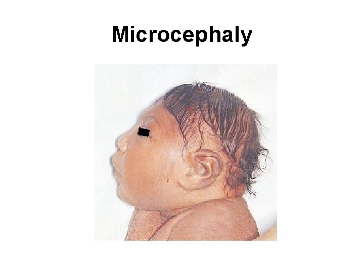 Microcephaly 