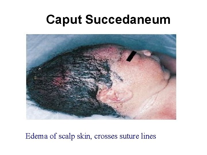 Caput Succedaneum Edema of scalp skin, crosses suture lines 