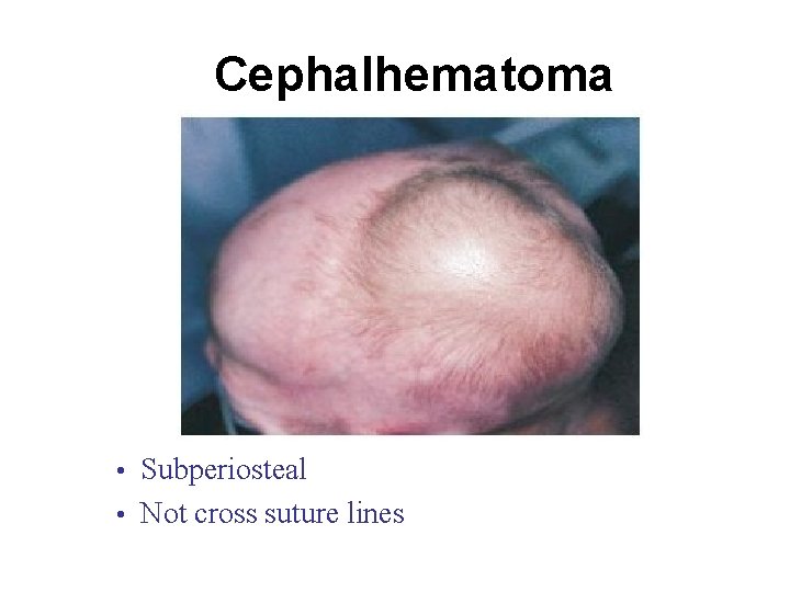 Cephalhematoma • Subperiosteal • Not cross suture lines 