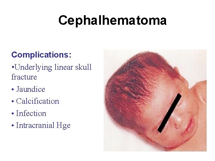 Cephalhematoma Complications: • Underlying linear skull fracture • Jaundice • Calcification • Infection •