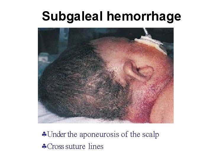Subgaleal hemorrhage Under the aponeurosis of the scalp Cross suture lines 