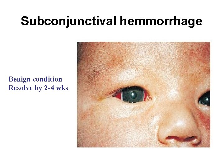 Subconjunctival hemmorrhage Benign condition Resolve by 2 -4 wks 