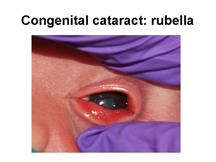 Congenital cataract: rubella 