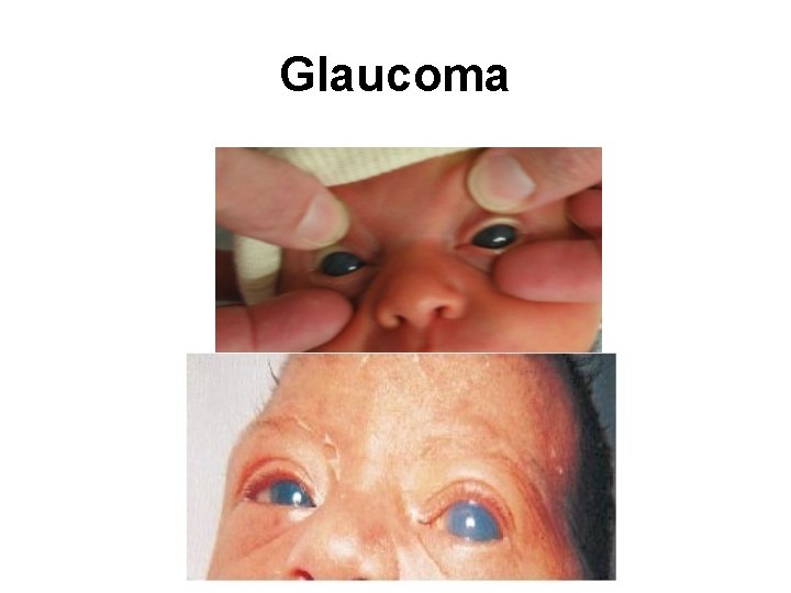 Glaucoma 