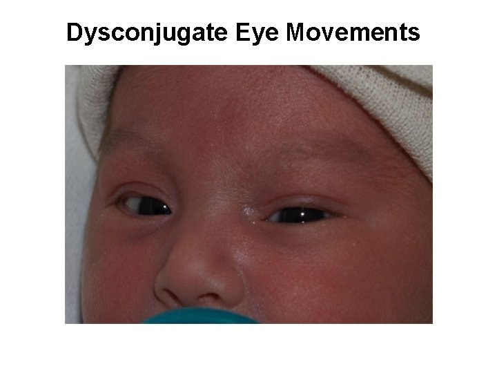 Dysconjugate Eye Movements 