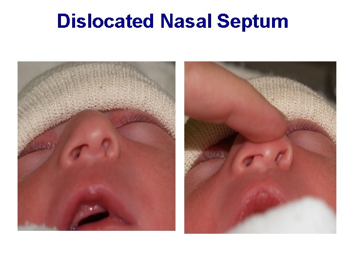 Dislocated Nasal Septum 