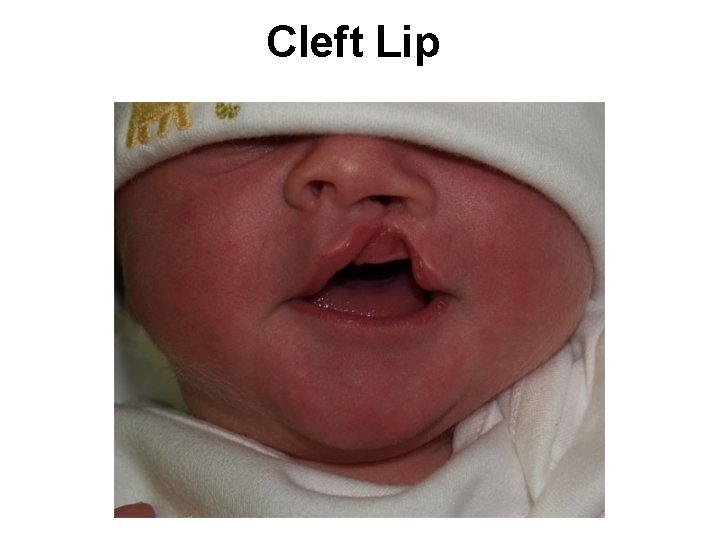 Cleft Lip 