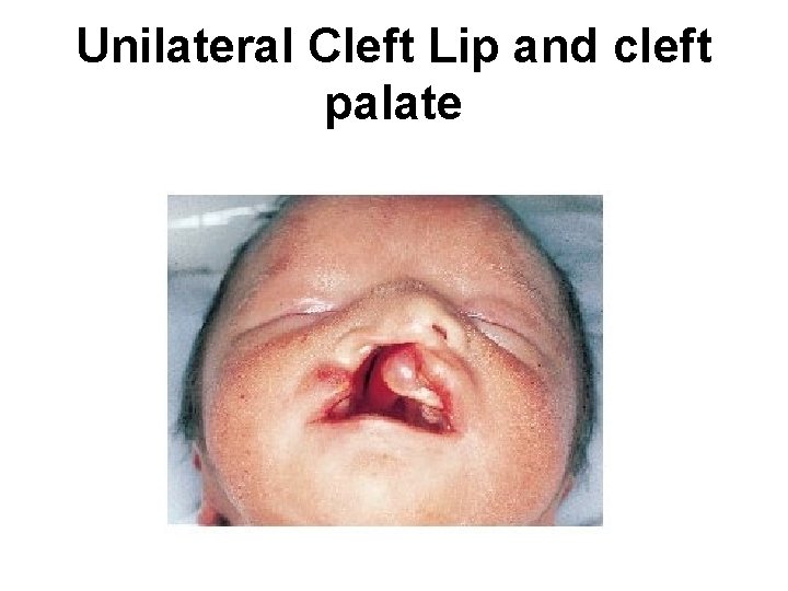 Unilateral Cleft Lip and cleft palate 