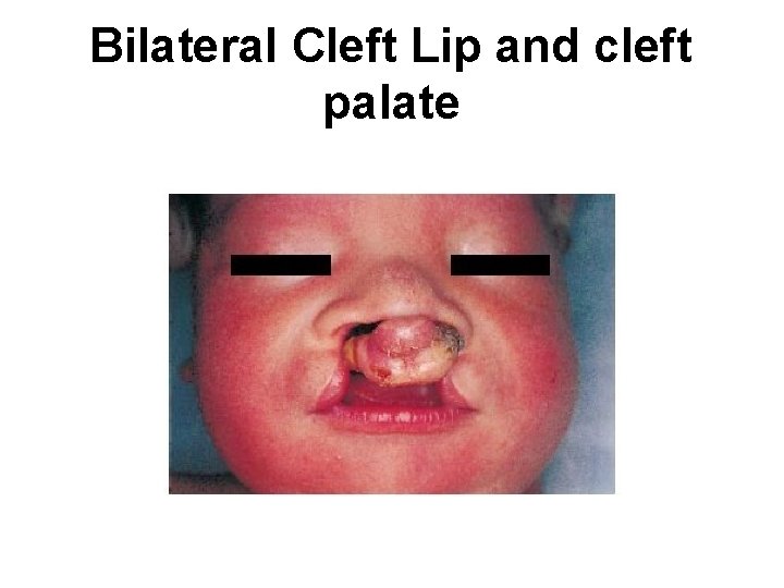 Bilateral Cleft Lip and cleft palate 