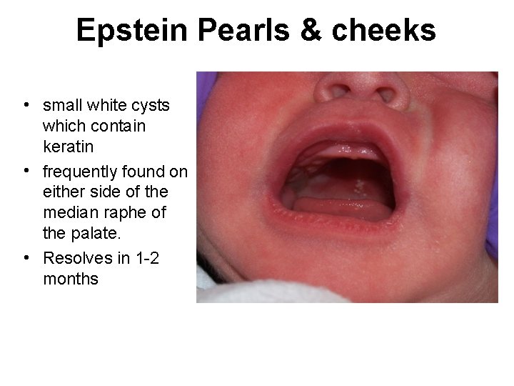 Epstein Pearls & cheeks • small white cysts which contain keratin • frequently found