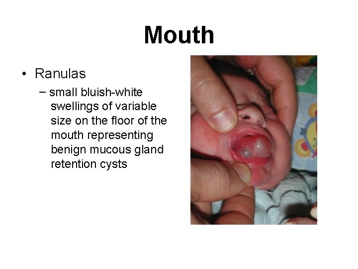 Mouth • Ranulas – small bluish-white swellings of variable size on the floor of