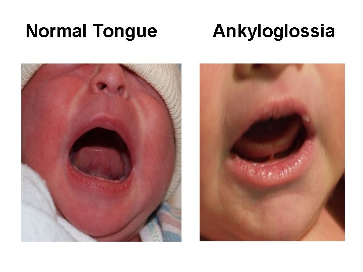 Normal Tongue Ankyloglossia 