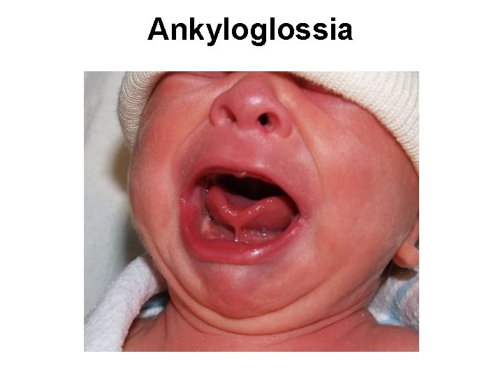 Ankyloglossia 