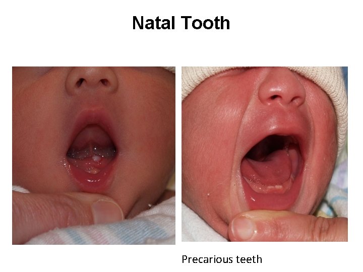Natal Tooth Precarious teeth 