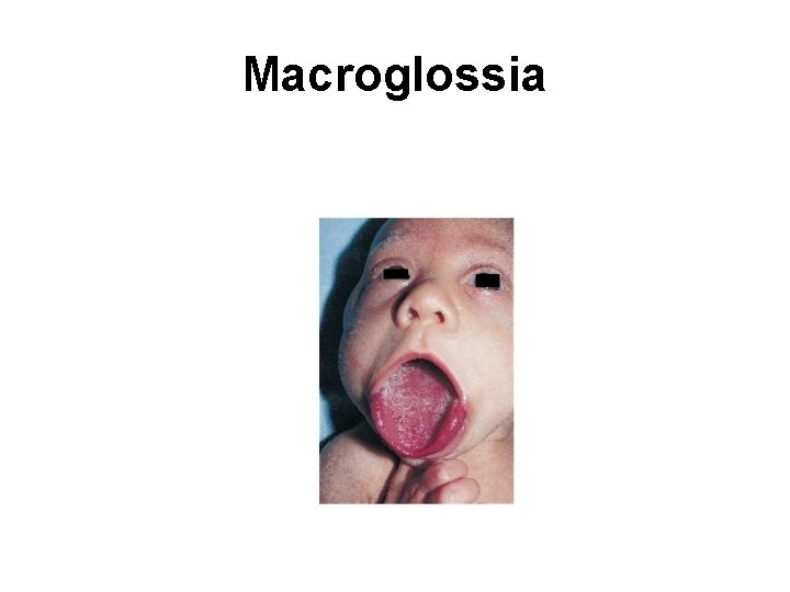 Macroglossia 