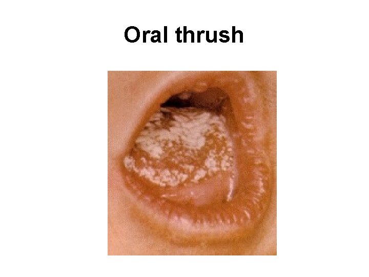 Oral thrush 