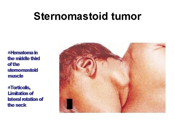 Sternomastoid tumor Hematoma in the middle third of the sternomastoid muscle Torticolis, Limitation of