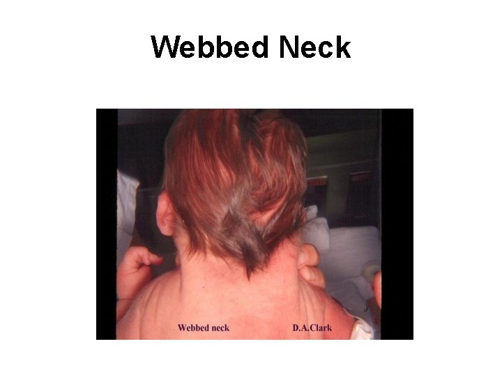Webbed Neck 
