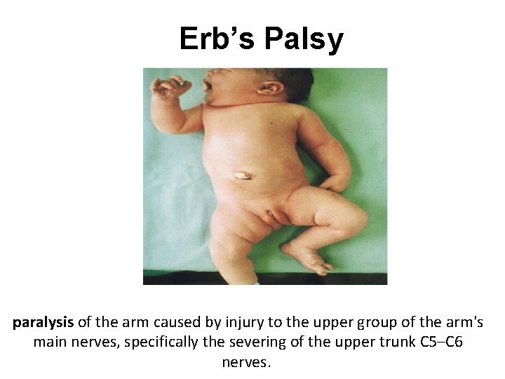 Erb’s Palsy paralysis of the arm caused by injury to the upper group of