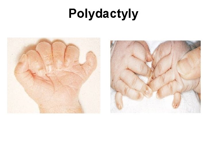 Polydactyly 