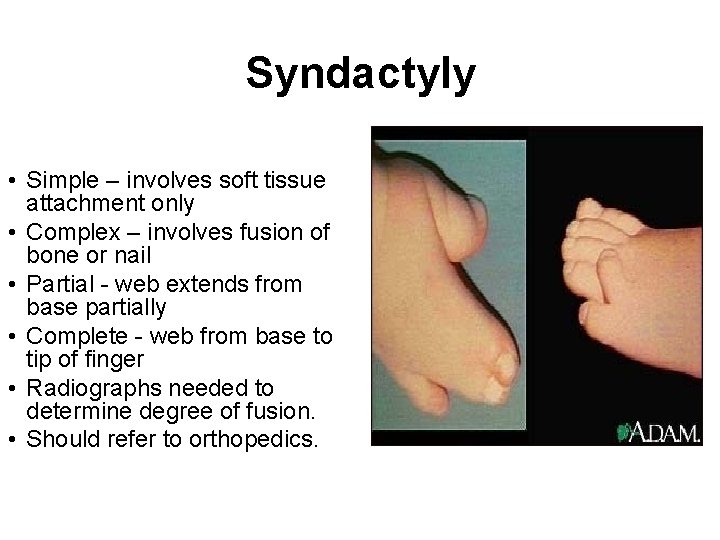 Syndactyly • Simple – involves soft tissue attachment only • Complex – involves fusion