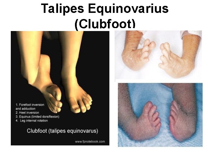 Talipes Equinovarius (Clubfoot) 