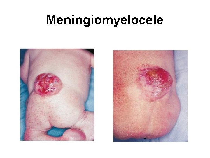 Meningiomyelocele 