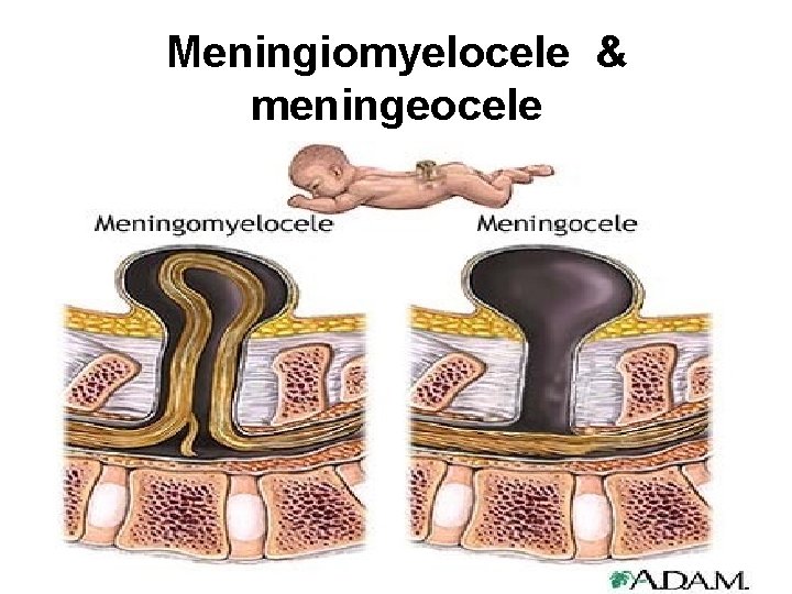 Meningiomyelocele & meningeocele 