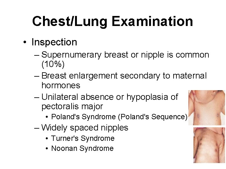 Chest/Lung Examination • Inspection – Supernumerary breast or nipple is common (10%) – Breast