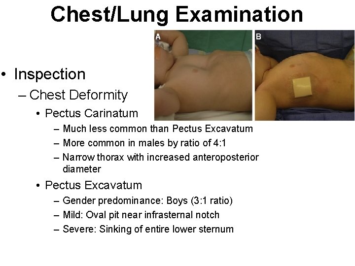 Chest/Lung Examination • Inspection – Chest Deformity • Pectus Carinatum – Much less common