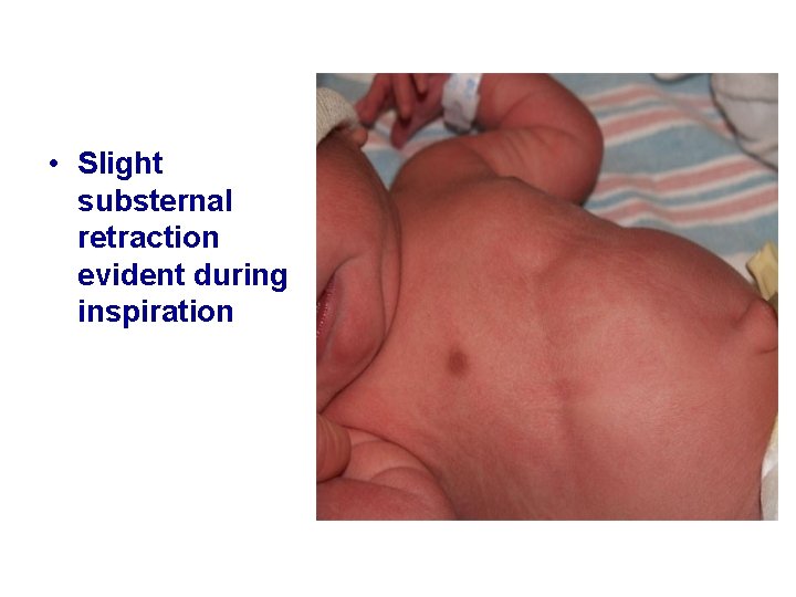  • Slight substernal retraction evident during inspiration 