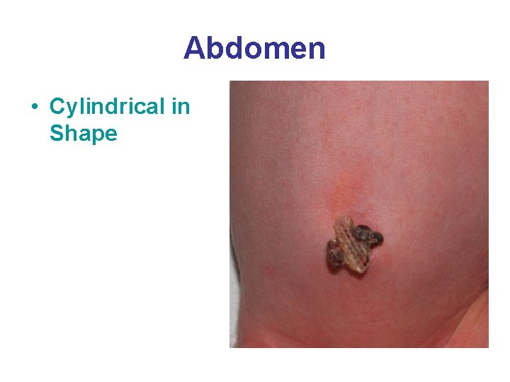 Abdomen • Cylindrical in Shape 