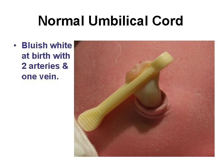 Normal Umbilical Cord • Bluish white at birth with 2 arteries & one vein.