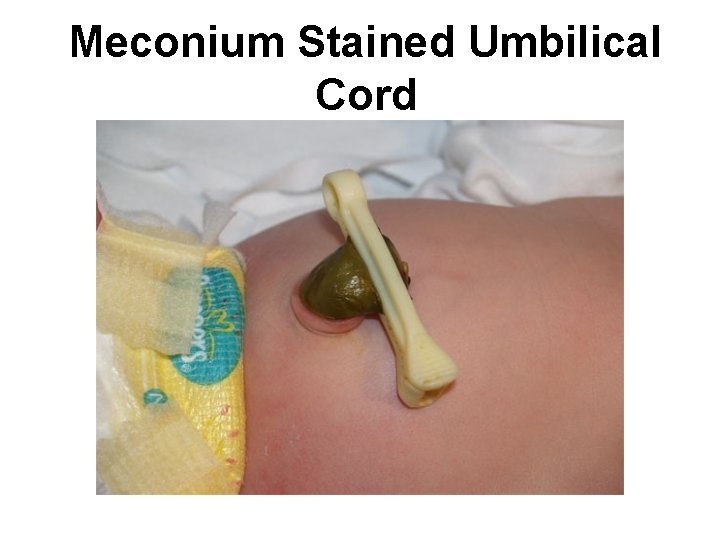 Meconium Stained Umbilical Cord 