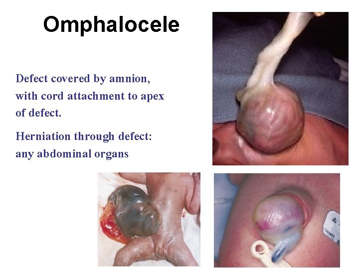 Omphalocele Defect covered by amnion, with cord attachment to apex of defect. Herniation through