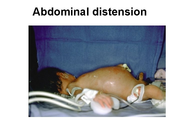 Abdominal distension 
